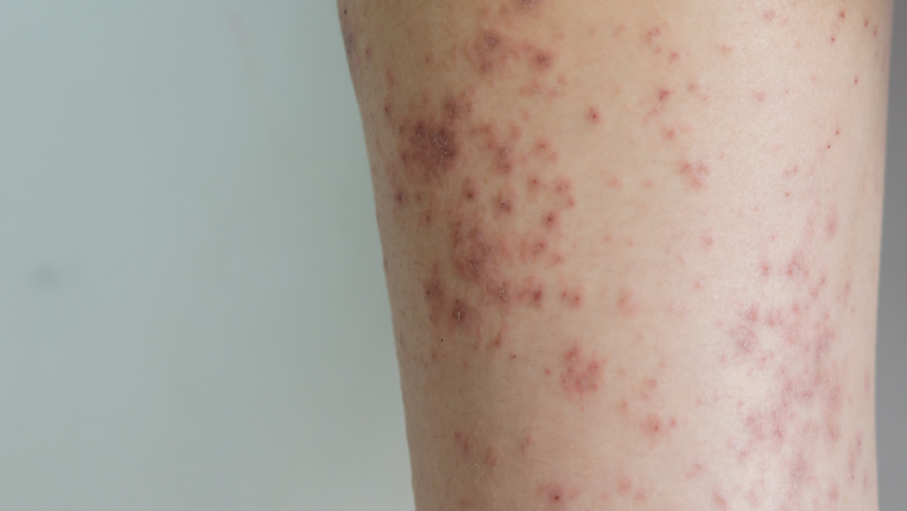 Home remedies for eczema