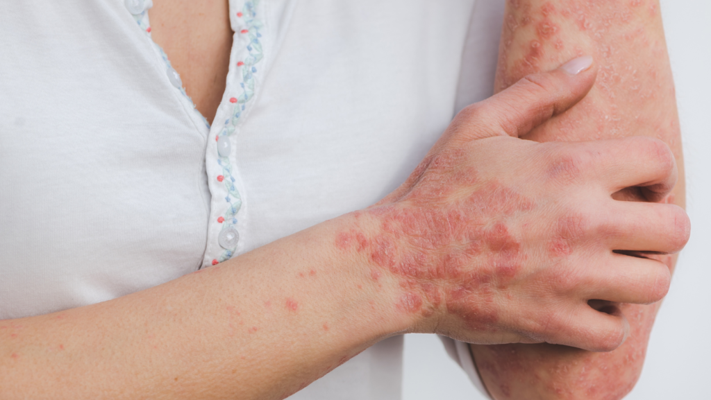 Home Remedies for Psoriasis